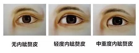 雙眼皮+開眼角為什么是較佳拍檔，一分鐘帶你看懂！