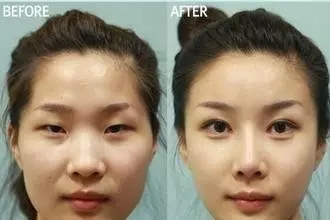 雙眼皮+開眼角為什么是較佳拍檔，一分鐘帶你看懂！