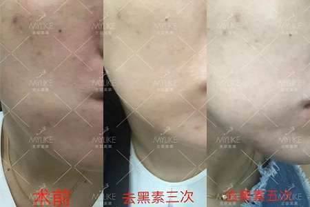 新品:英諾祛斑北京美萊發(fā)布會(huì)圓滿舉行