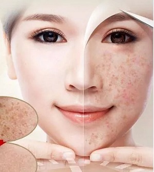 問診室：祛斑后皮膚能年輕十歲？關于祛斑的這些問題你知道嗎？