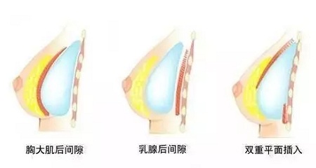 自體脂肪or假體隆胸，我到底應(yīng)該怎么選？