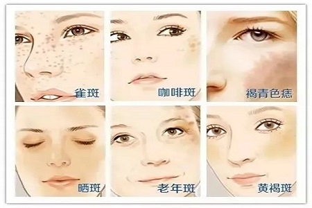 祛了那么多年的斑，你的斑去掉了嗎？