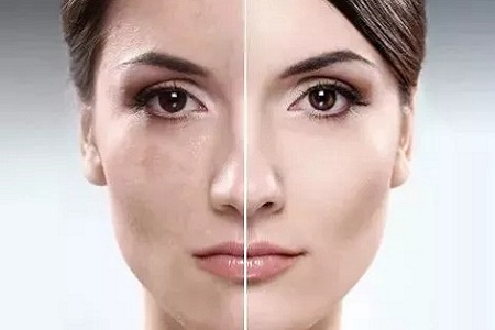 祛了那么多年的斑，你的斑去掉了嗎？