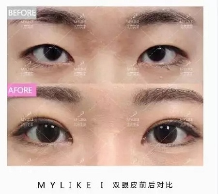 問診室:眼整形犯糊涂的那些事兒