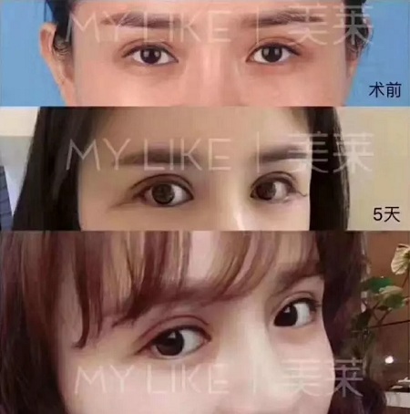 問診室:眼整形犯糊涂的那些事兒