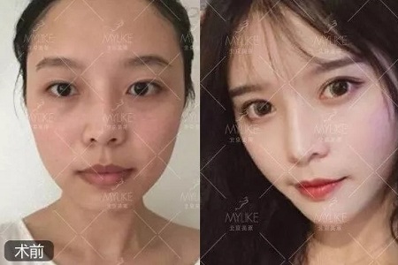 問診室:眼整形犯糊涂的那些事兒