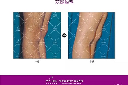 新品:黑科技脫毛金標準了解一下?