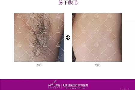 新品:黑科技脫毛金標準了解一下?