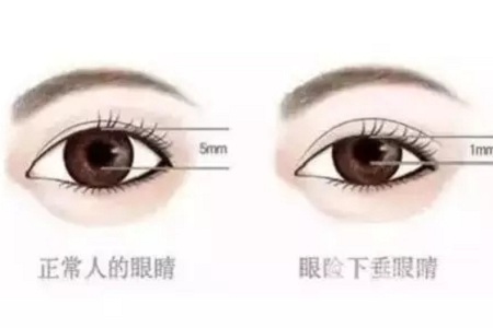 問診室:做雙眼皮前,這些問題你需要提前了解!