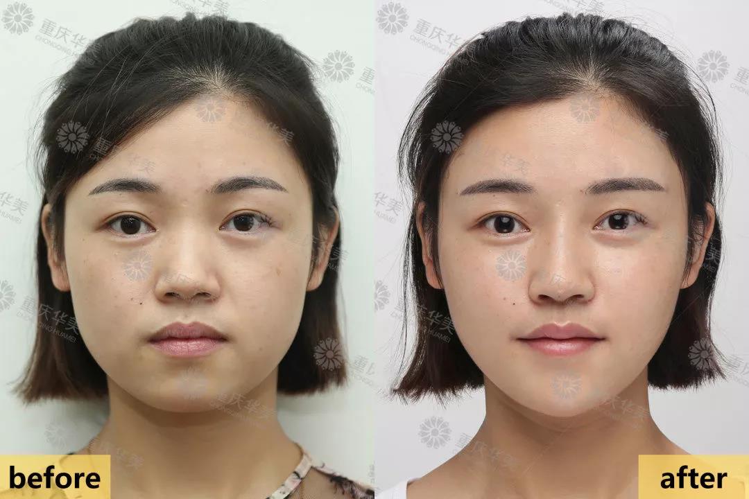 玻尿酸or自體脂肪，哪個更適合面部填充？