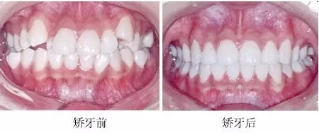 新品:整牙=換臉?隱適美IGO實現所有不可能!