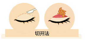 雙眼皮我想做埋線，為什么醫(yī)師建議我做全切雙眼皮