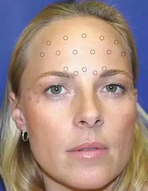 你無法用玻尿酸除掉所有皺紋!