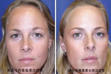 你無法用玻尿酸除掉所有皺紋!