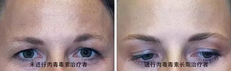 你無法用玻尿酸除掉所有皺紋!