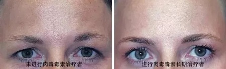 你無法用玻尿酸除掉所有皺紋!