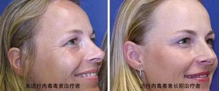 你無法用玻尿酸除掉所有皺紋!