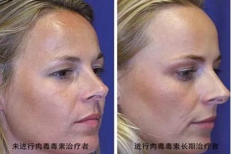 你無法用玻尿酸除掉所有皺紋!