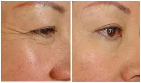 你無法用玻尿酸除掉所有皺紋!