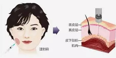 瘦臉會(huì)導(dǎo)致臉部凹陷松弛?