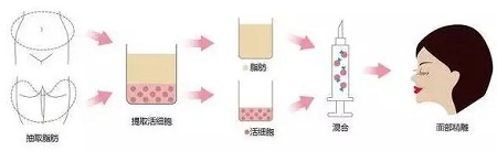 明星的臉和你的臉差的只是這一步!--面部脂肪填充