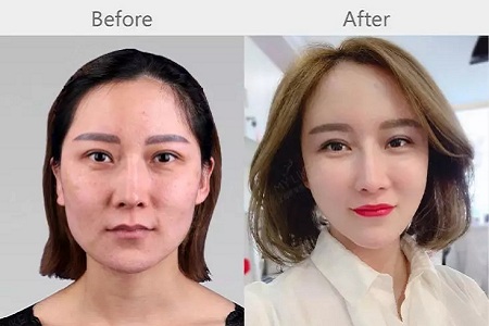 明星的臉和你的臉差的只是這一步!--面部脂肪填充