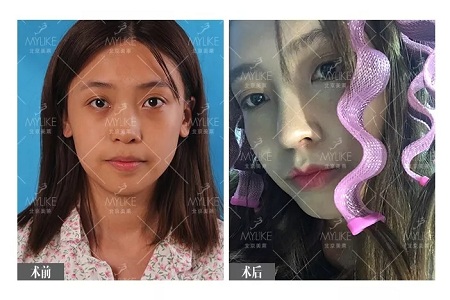 顏值:鼻子一小步,顏值一大步~