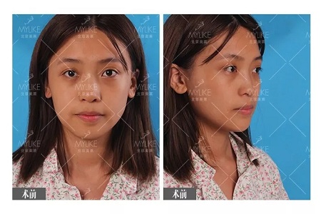 顏值:鼻子一小步,顏值一大步~