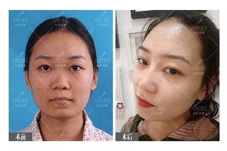 顏值:插座鼻變小翹鼻,就是這么神奇!