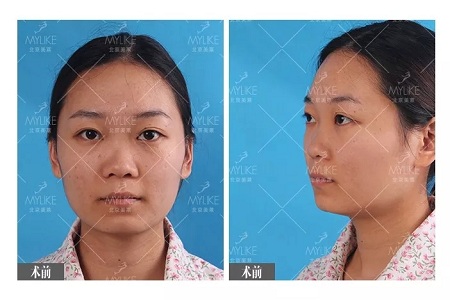 顏值:插座鼻變小翹鼻,就是這么神奇!