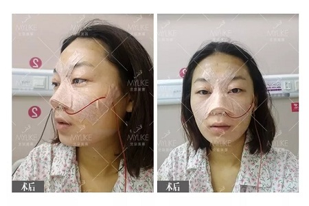 顏值:插座鼻變小翹鼻,就是這么神奇!