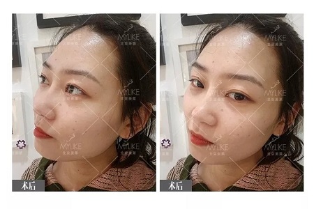 顏值:插座鼻變小翹鼻,就是這么神奇!