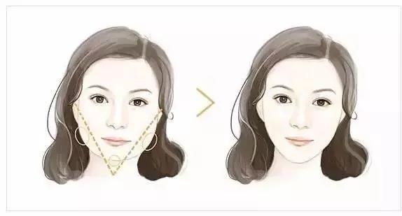 玻尿酸+瘦臉這樣打，方臉、大餅?zāi)樁寄茏冃臉！