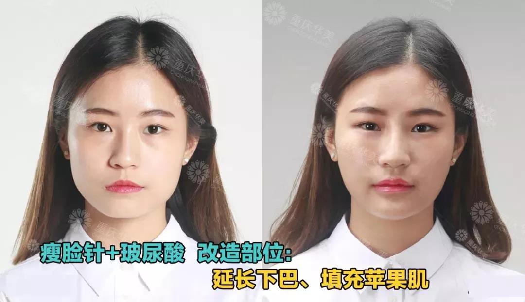 玻尿酸+瘦臉這樣打，方臉、大餅?zāi)樁寄茏冃臉！