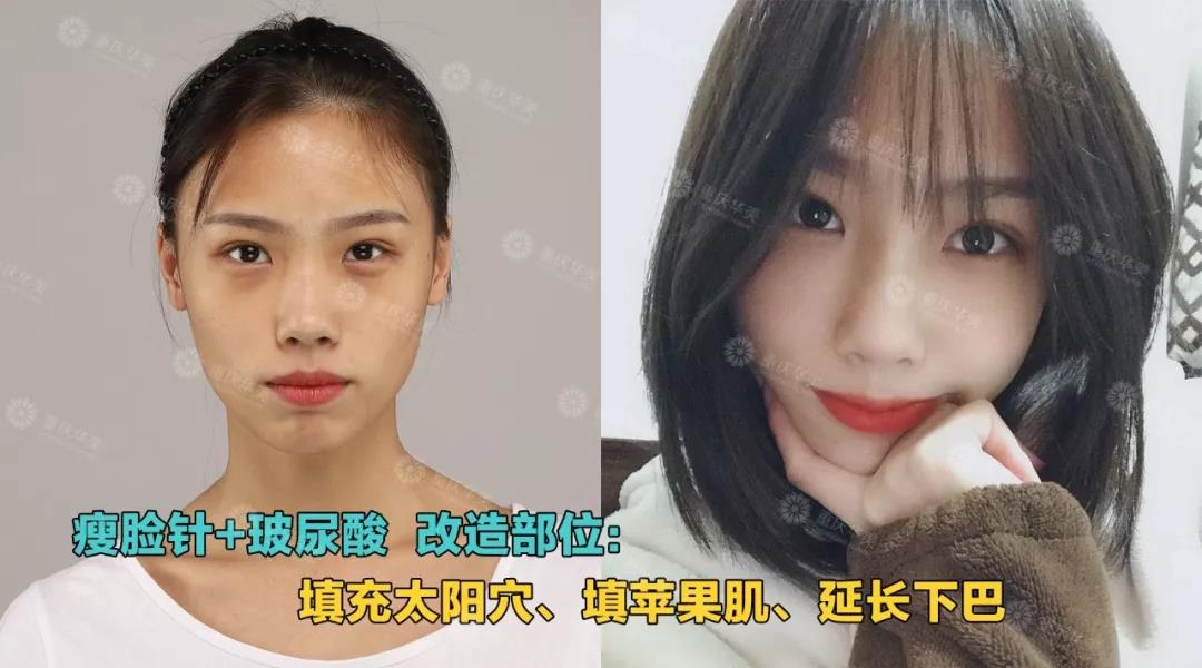 玻尿酸+瘦臉針這樣打，方臉、大餅?zāi)樁寄茏冃臉！