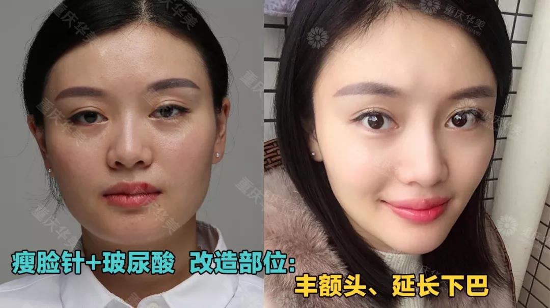 玻尿酸+瘦臉這樣打，方臉、大餅?zāi)樁寄茏冃臉！