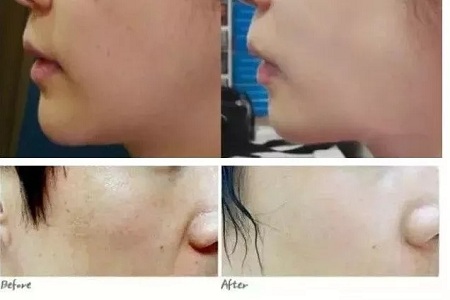 水光,打1次和4次究竟有多大區別?