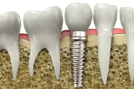 美萊牙齒矯正,讓你吃的香吃的好重享美味