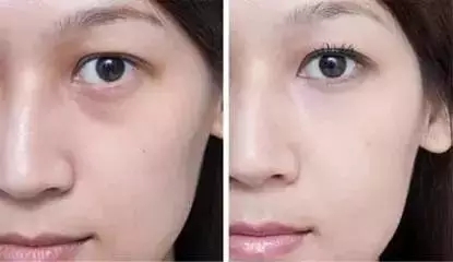 還把眼袋當臥蠶?那就別怪小弟弟喊你阿姨了