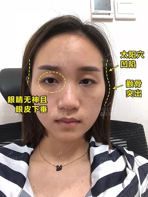 自體脂肪+雙眼皮,這對cp你不pick一下嗎?