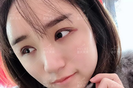 自體脂肪+雙眼皮,這對cp你不pick一下嗎?