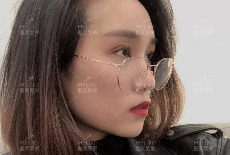 自體脂肪+雙眼皮,這對cp你不pick一下嗎?