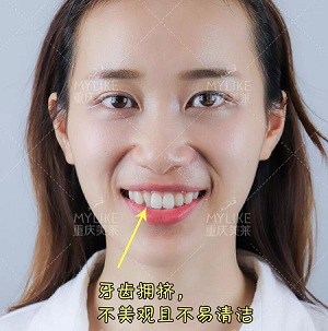 這種牙齒矯正方式,96%的人都會選擇!