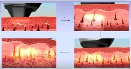 既便宜又安全的脫毛方法是什么?