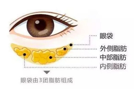 去掉眼袋,刻不容緩,別等又大又松弛才做