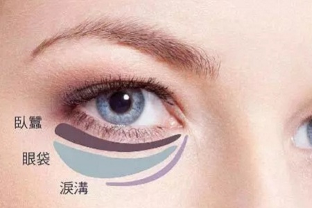 去掉眼袋,刻不容緩,別等又大又松弛才做