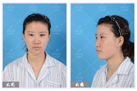 顏值:修復后的雙眼,美瞎一路