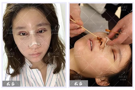 顏值:修復后的雙眼,美瞎一路