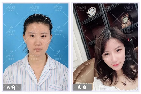 顏值:修復后的雙眼,美瞎一路