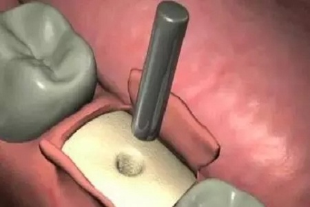 揭秘牙齒矯正的全過程!!!